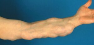 cyst treatment Lakewood CA