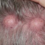 rosacea treatment Irvine CA