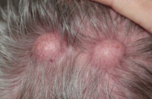 rosacea treatment Irvine CA