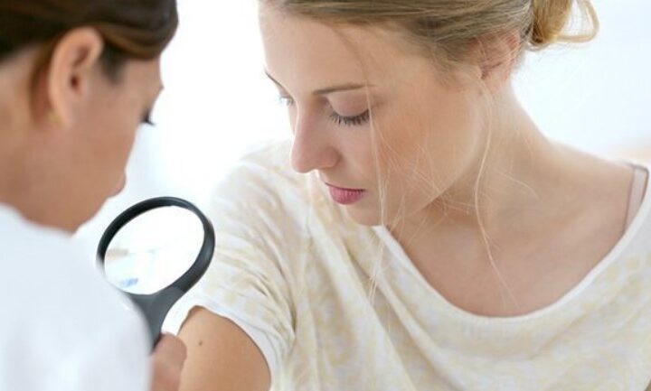 acne treatment Westminster CA