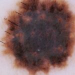 rosacea treatment mission Viejo CA