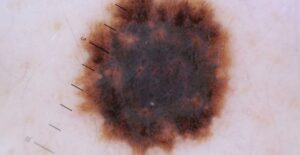rosacea treatment mission Viejo CA