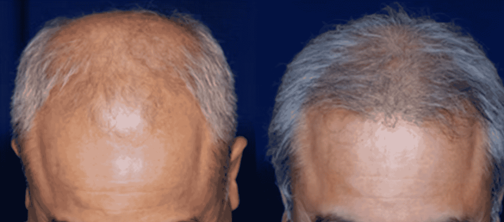 New Jersey hair loss treatment center