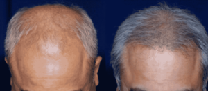 New Jersey hair loss treatment center