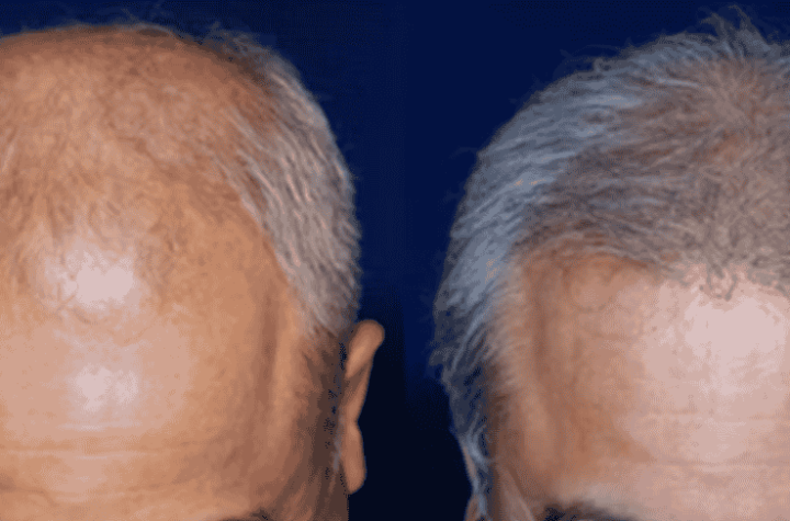 New Jersey hair loss treatment center