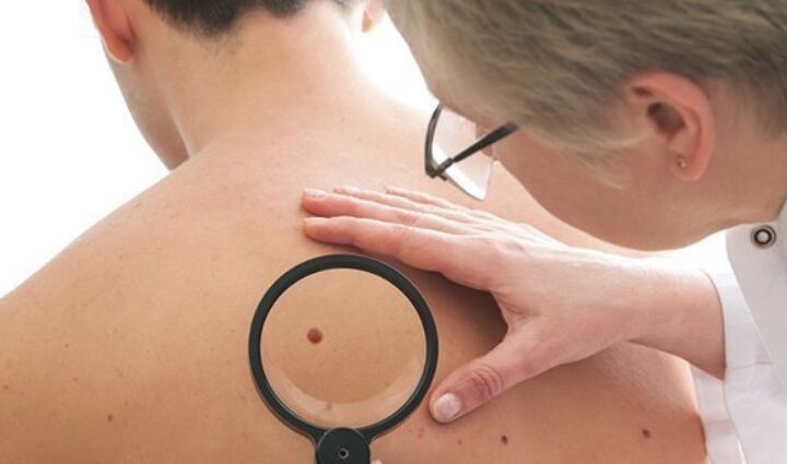 squamous cell carcinoma treatment cypress ca